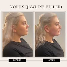 Jawline Filler